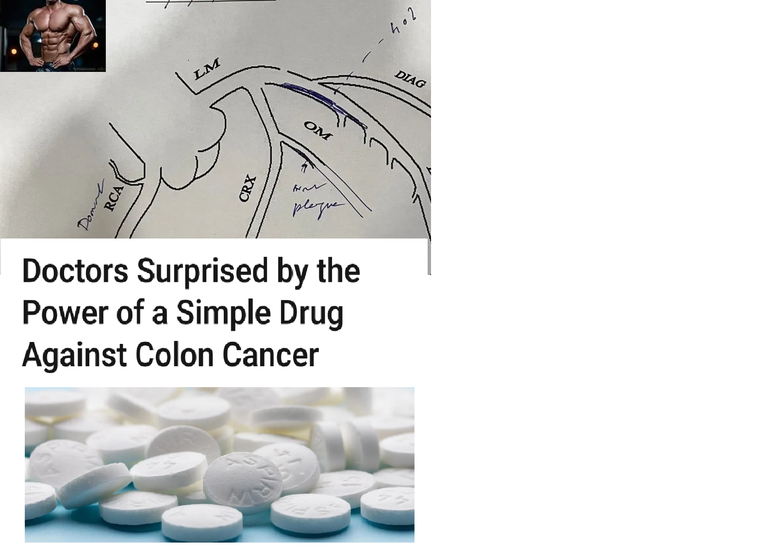 Aspirin, Heart Disease and Young India